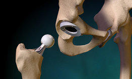 Su traumatólogo Ortopedista le sugerirá el tipo de prótesis de cadera mas adecuada para su padecimiento